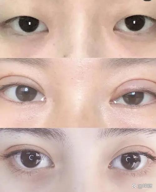 單眼皮跟內雙一樣嗎