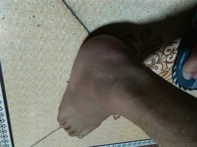 腳翻船要看醫生嗎?詳細判斷指南與處理建議 1 腳翻船要看醫生嗎