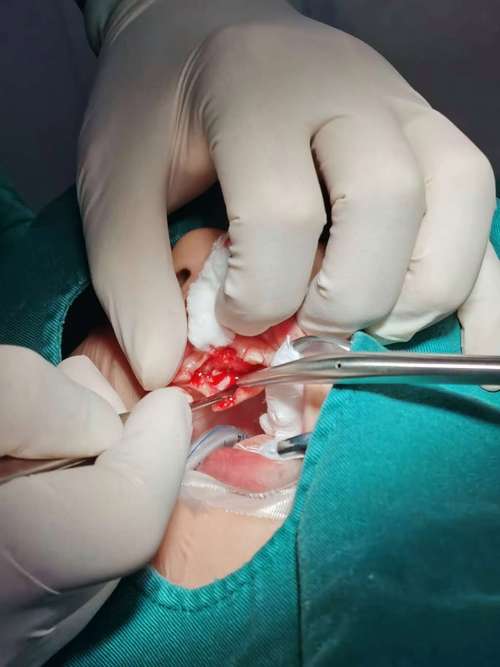 多生牙一定要拔嗎