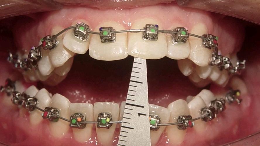 開咬一定要矯正嗎