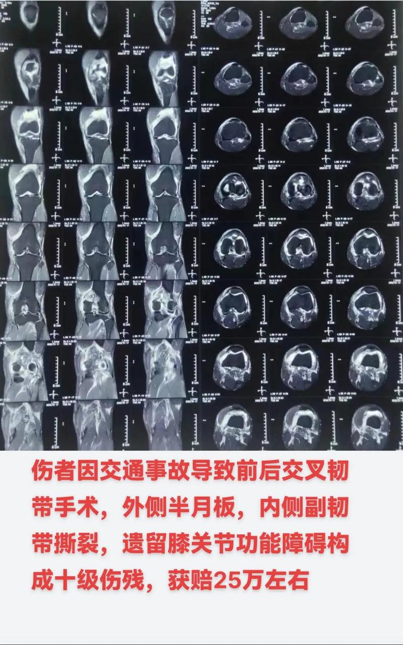 韌帶斷掉有後遺症嗎