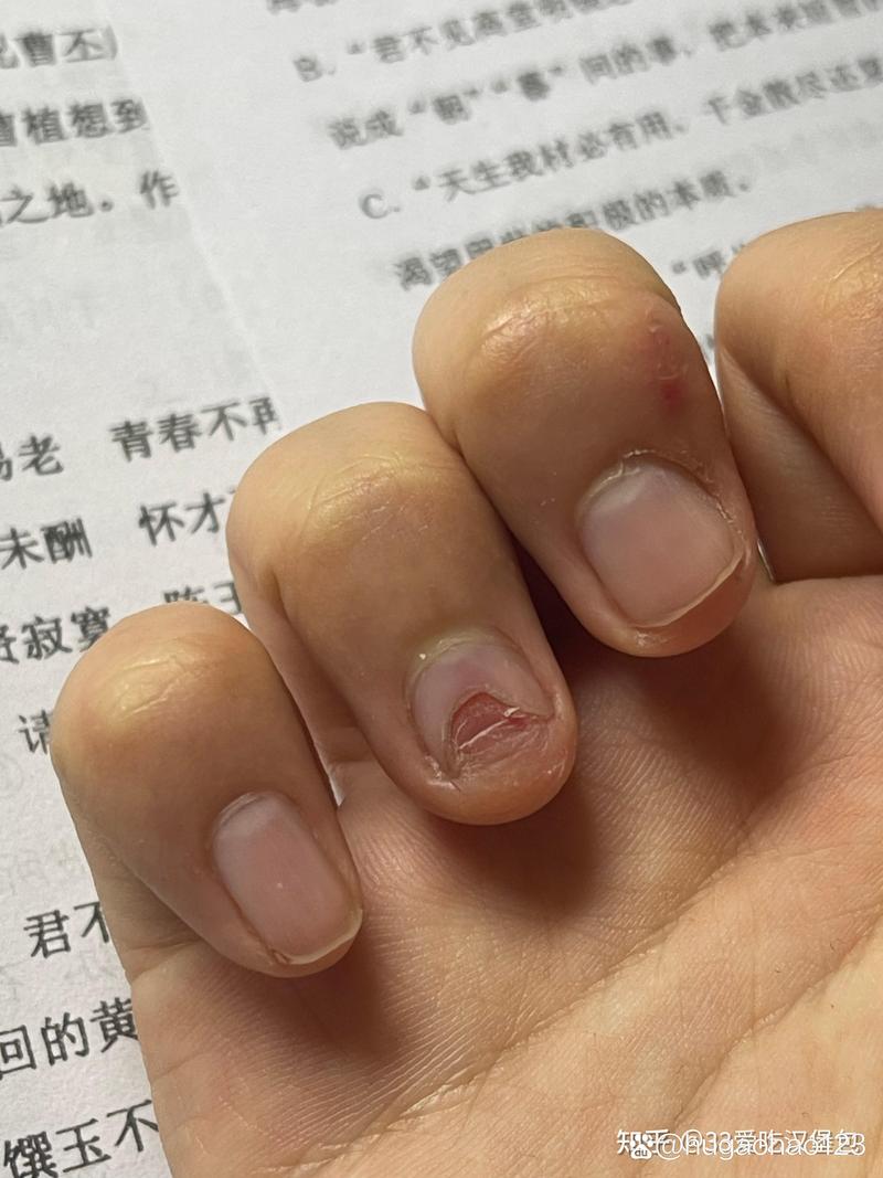 大人咬指甲:深度解析成因、危害與告別咬甲習慣的有效策略 1 大人咬指甲