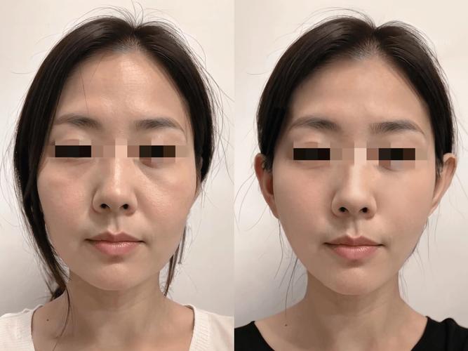 筋膜提升是拉皮嗎