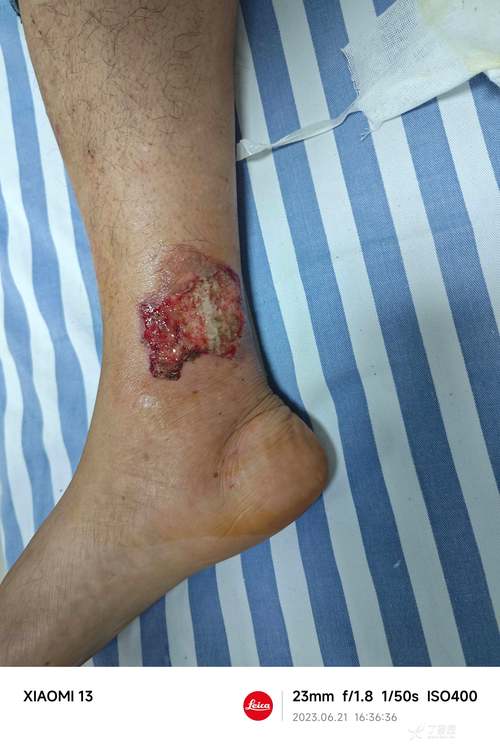 被排氣管燙到可以告嗎