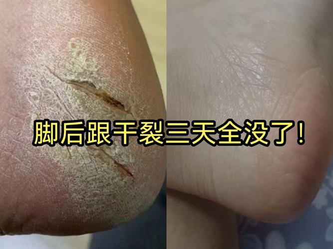 後腳跟龜裂