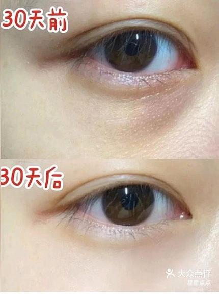 皮秒可以消黑眼圈嗎