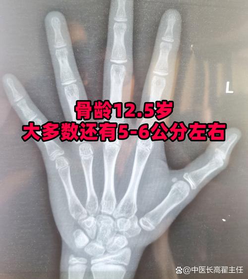 骨齡可以長到幾歲