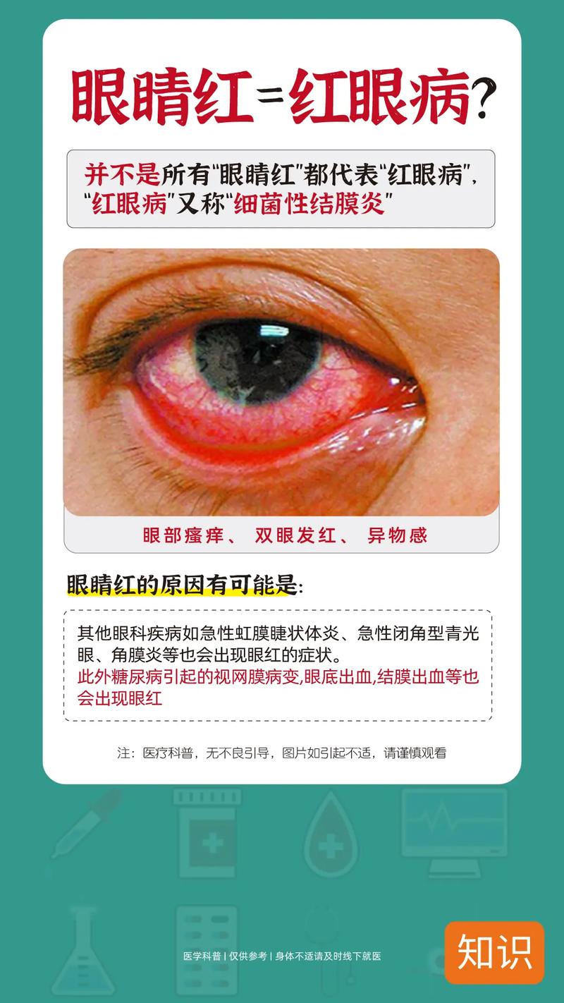 紅眼症可以上課嗎