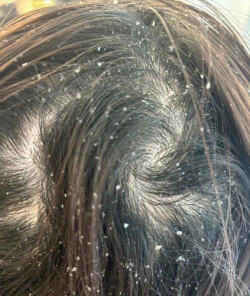 熬夜會長頭皮屑嗎揭開夜貓子與頭皮健康的秘密 3 熬夜會長頭皮屑嗎