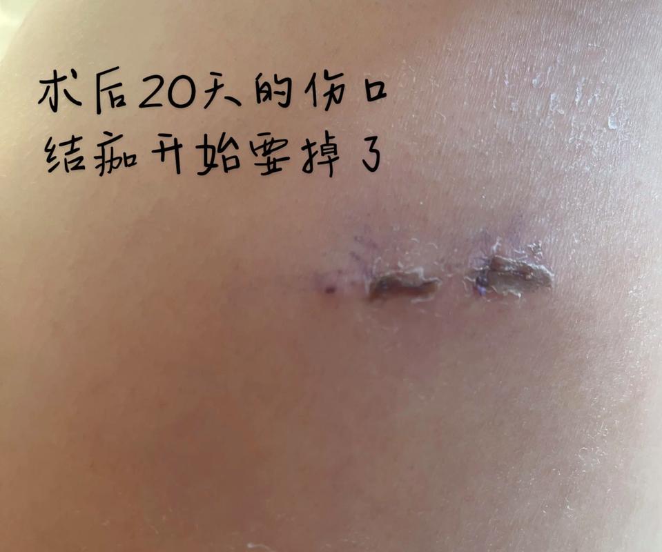 肺結節手術後遺症