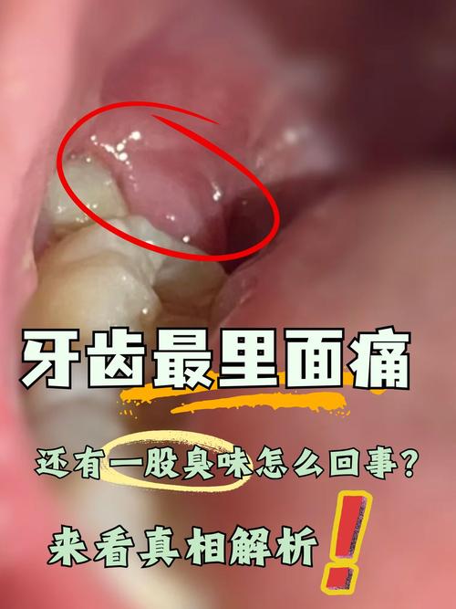 吃太甜牙齒痛:深度解析甜食引發牙痛的原因、舒緩與預防之道 1 吃太甜牙齒痛