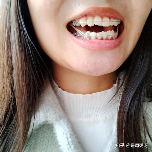 牙套拉橡皮筋很痛怎麼辦
