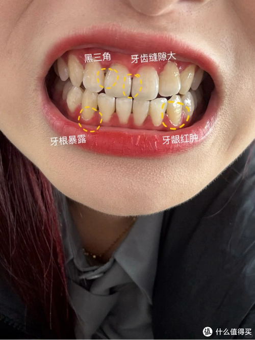 幾歲牙齦萎縮:揭開牙齦萎縮的年齡迷思與預防照護全攻略 1 幾歲牙齦萎縮