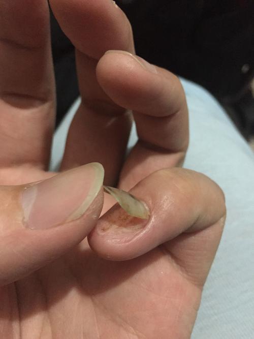 指甲全部拔掉會長出來嗎