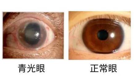 虹視一定是青光眼嗎