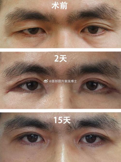 割雙眼皮 能出國嗎