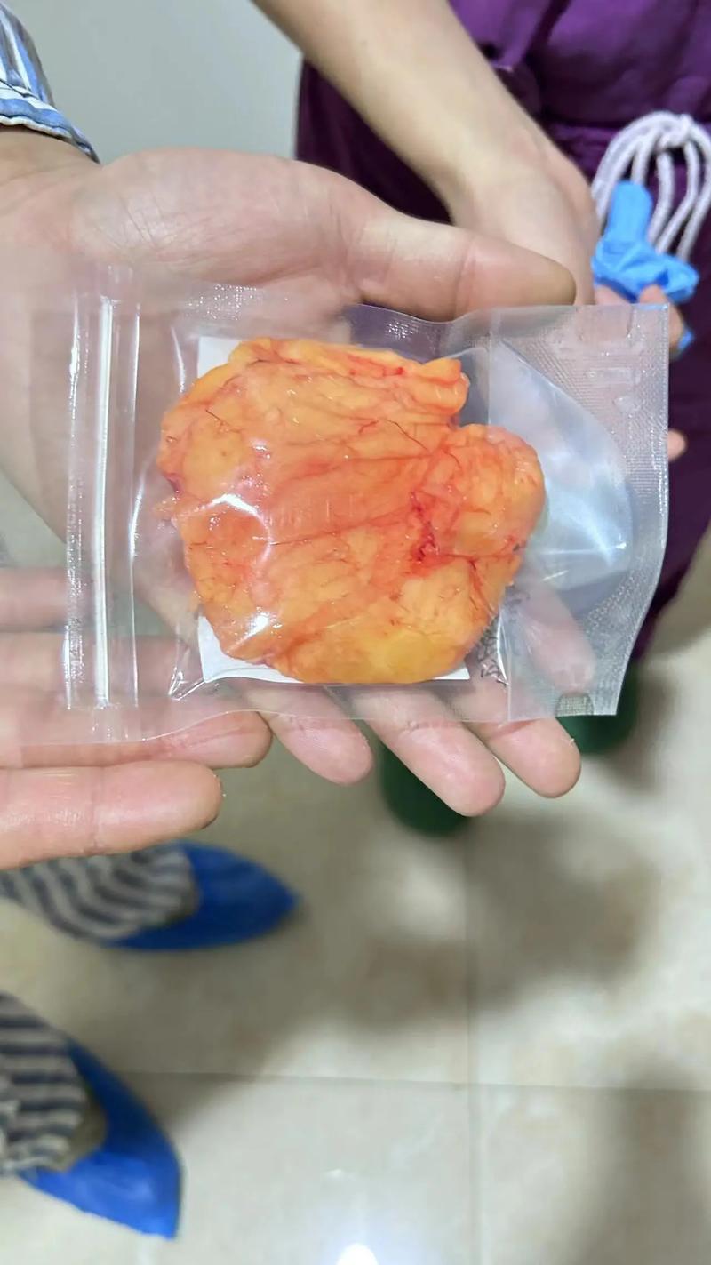 脂肪瘤切除多少錢:完整費用解析、影響因素與健保給付全攻略 3 脂肪瘤切除多少錢