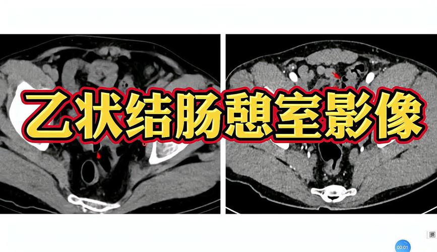 大腸憩室炎有什麼症狀:一篇詳盡解析其症狀、警訊與併發症 3 大腸憩室炎有什麼症狀