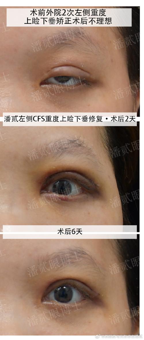 眼皮下垂健保有給付嗎