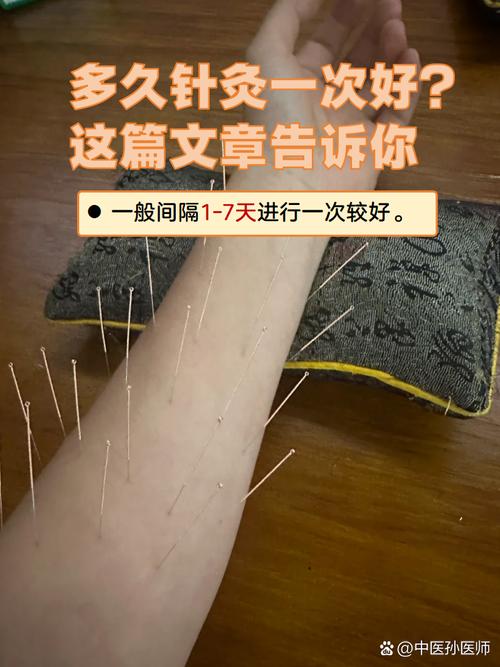 幾天可以針灸一次