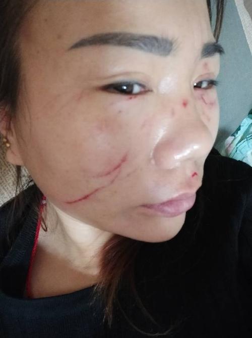 羅嘉翎受什麼傷:深入解析台灣跆拳道新星的傷勢與復健之路 1 羅嘉翎受什麼傷