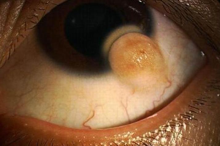 結膜囊腫會自己好嗎