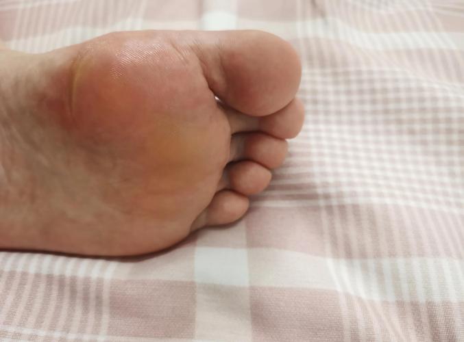 如何去除腳底硬皮