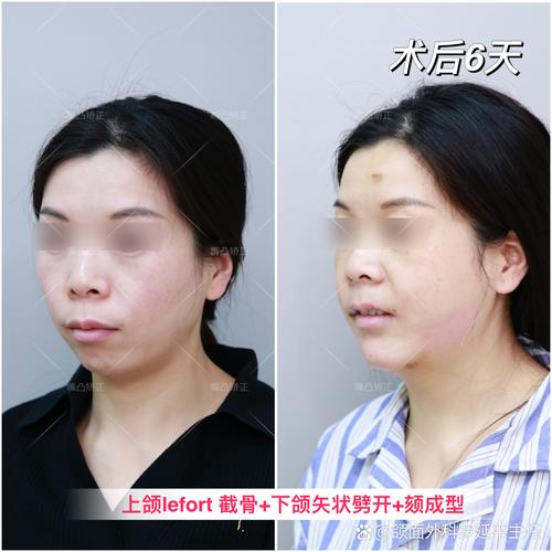 正顎幾歲可以做:從骨骼發育到成人,各階段手術時機全解析 1 正顎幾歲可以做