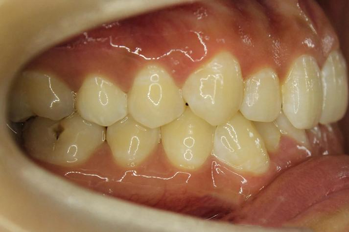 下排牙齒癢:難以忍受的搔癢感?解析原因、緩解策略與就醫時機全攻略 1 下排牙齒癢