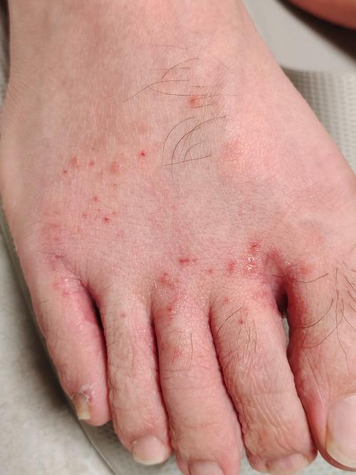 腳底脫皮怎麼辦?深入解析原因、有效治療與居家護理全攻略,告別惱人足部困擾! 1 腳底脫皮