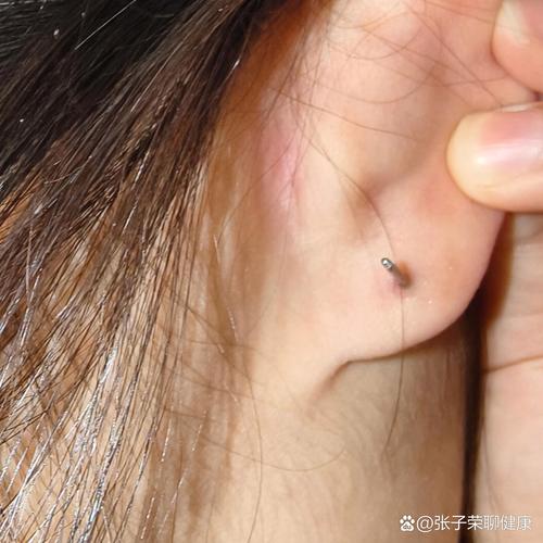 耳洞臭