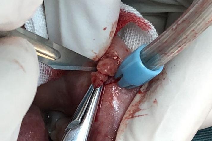 為什麼會長黏液囊腫