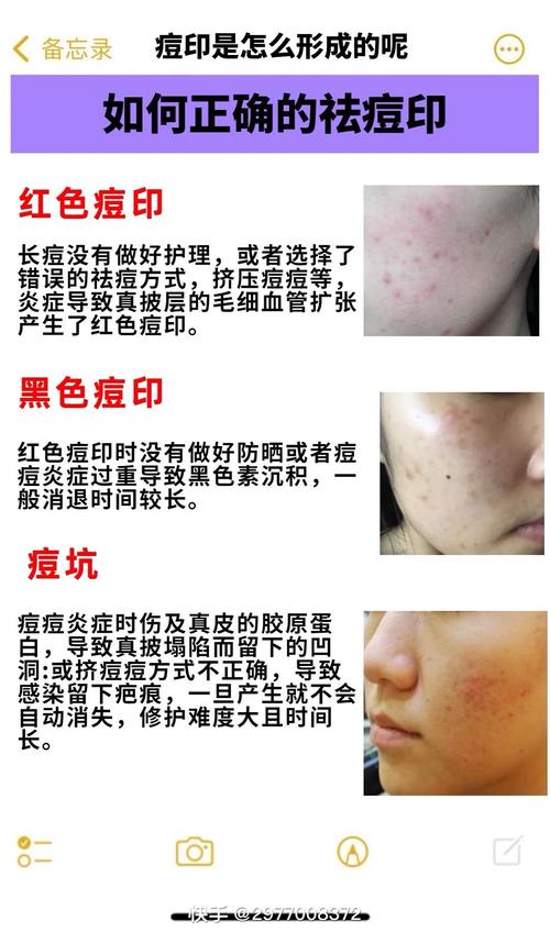 痘印怎麼形成:深入解析痘疤、痘印的成因與預防 1 痘印怎麼形成