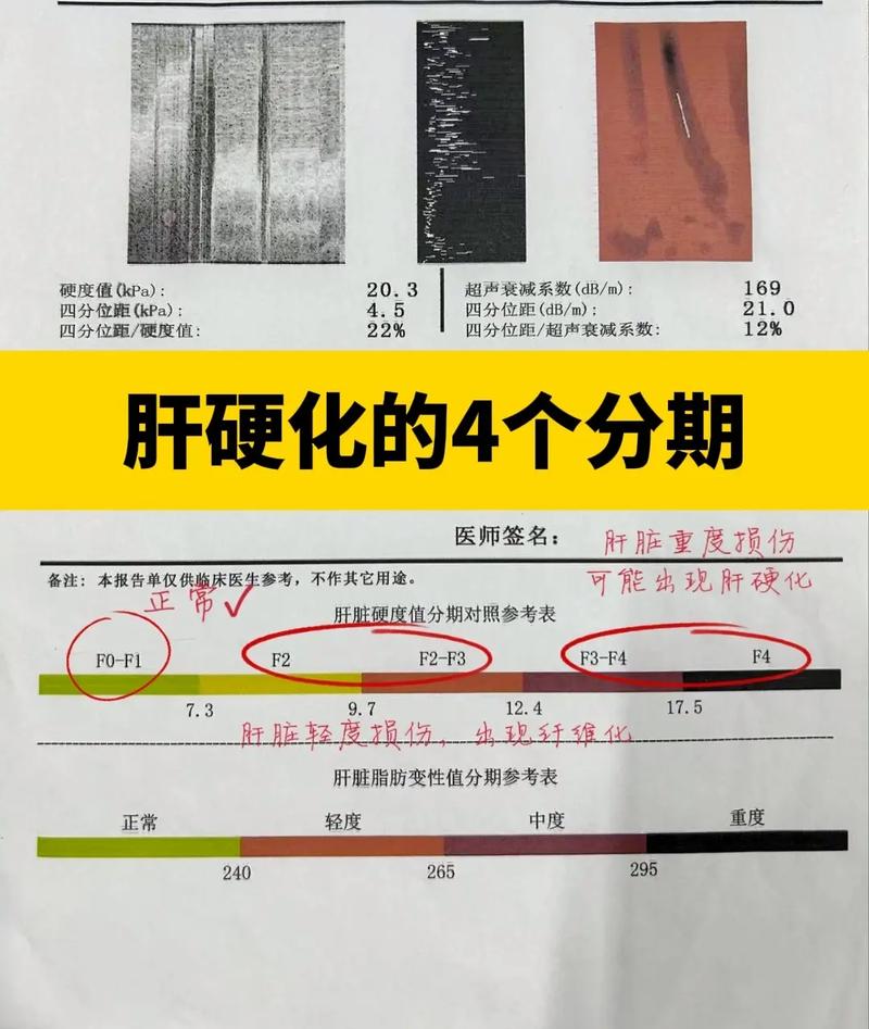 肝纖維化可以活多久:深度解析、影響因素與展望 1 肝纖維化可以活多久