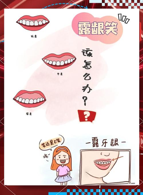 露牙齦會遺傳嗎:全面解析露齦笑的遺傳因素與成因 1 露牙齦會遺傳嗎