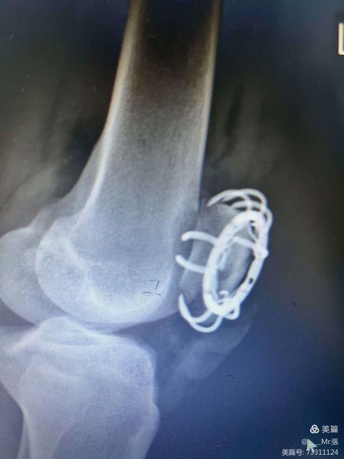 髕骨骨折不開刀您的最佳復原指南:完整解析非手術治療選擇、復健與注意事項 1 髕骨骨折不開刀