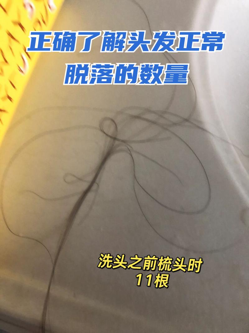 一天掉髮多少算正常
