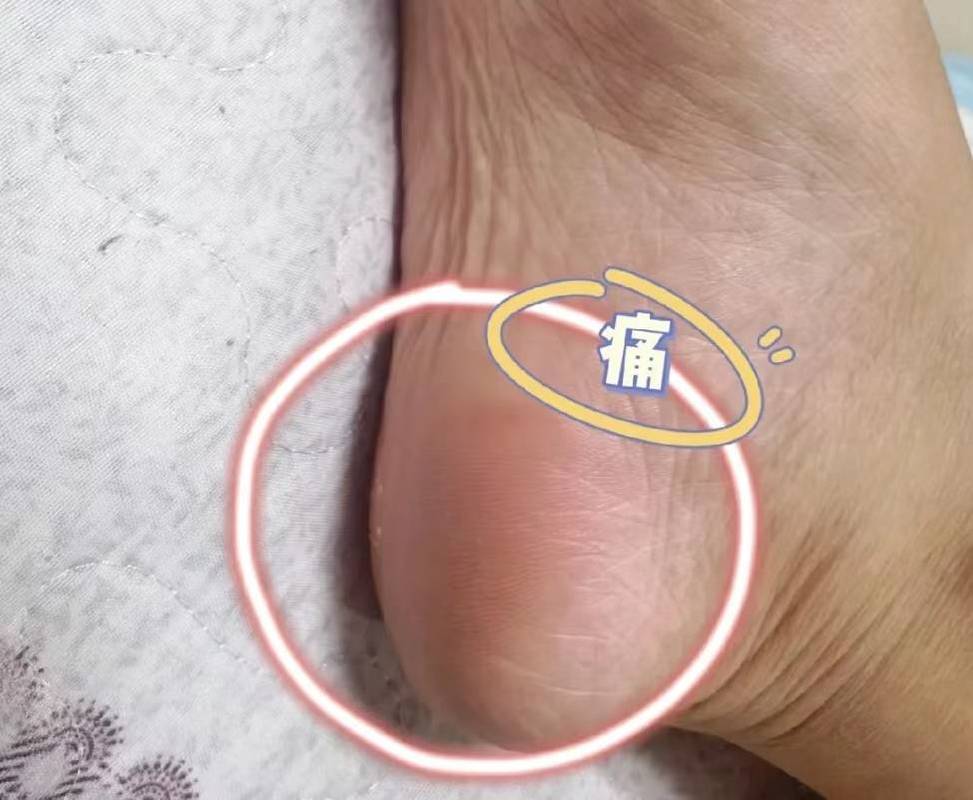 足底脂肪墊萎縮怎麼辦