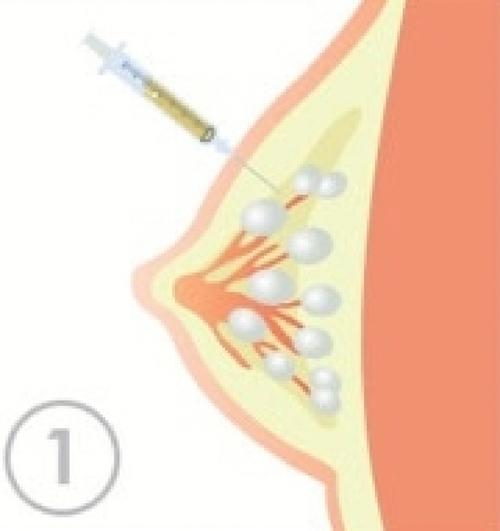 隆乳後多久可以出國