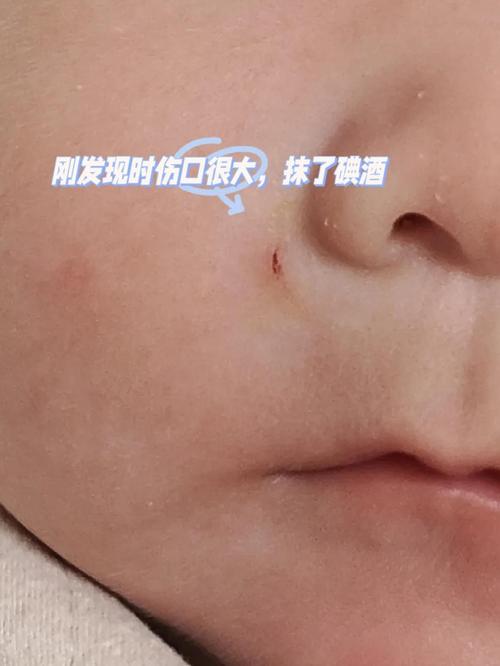 寶寶抓傷擦什麼