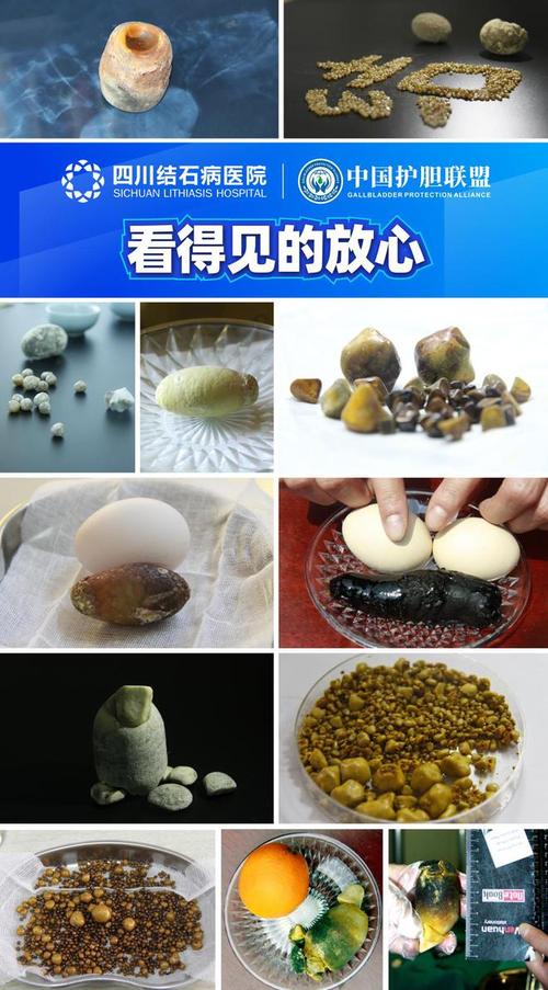 膽拿掉會怎樣嗎:一篇關於膽囊切除術後影響的深度解析 3 膽拿掉會怎樣嗎