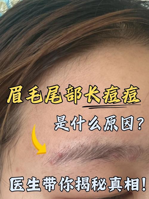 為什麼眉心會長痘痘:深入解析、成因與有效對策 1 為什麼眉心會長痘痘