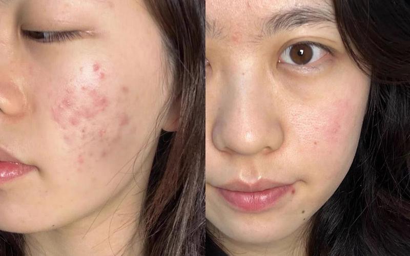 臉洗太乾淨會長痘痘嗎