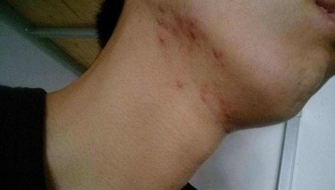 脖子長一粒一粒的是什麼:完整解析、成因、照護與就醫指引 3 脖子長一粒一粒的是什麼