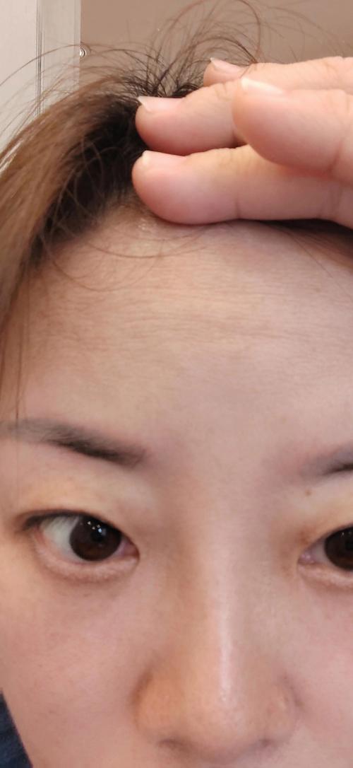 抬頭紋打什麼:全面解析肉毒桿菌、玻尿酸等注射療程與選擇指南 3 抬頭紋打什麼