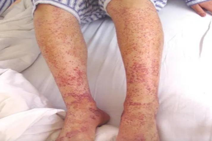 皮膚紫質是什麼