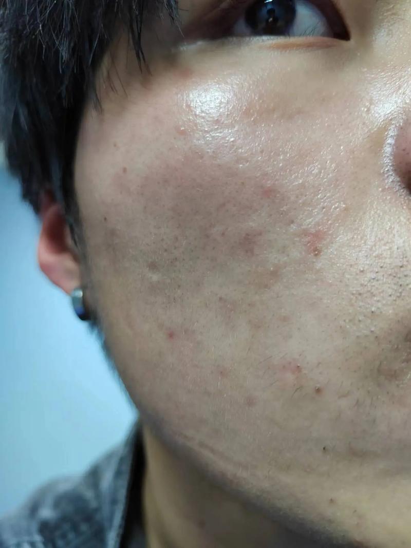 為什麼臉很容易紅