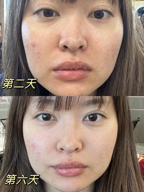 微針 可以上妝嗎