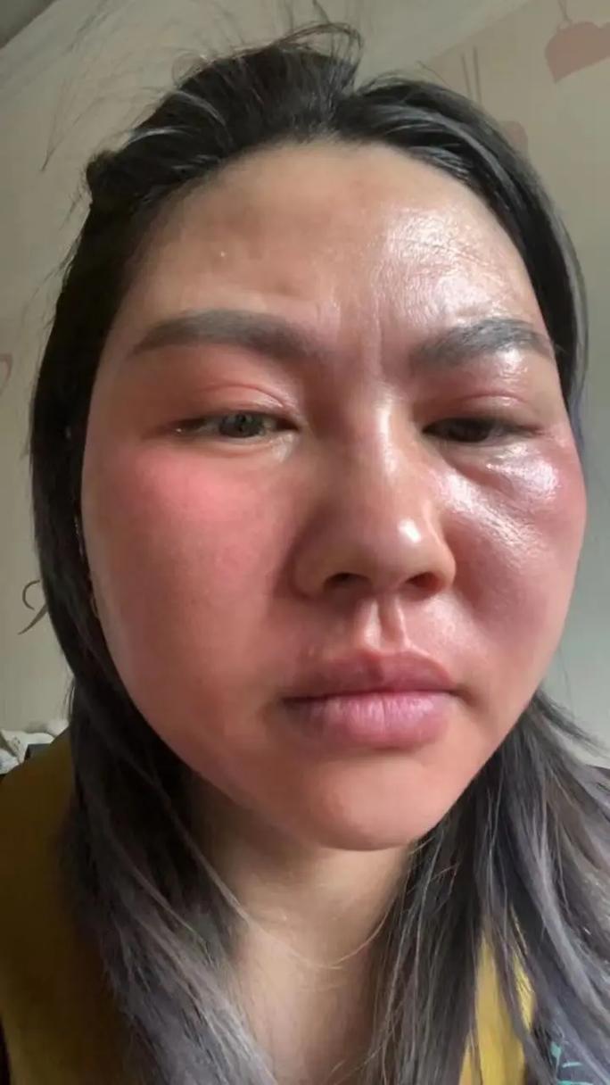 喝太多水臉會腫嗎