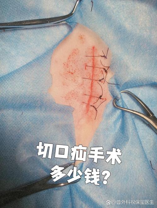 疝氣手術要多少錢